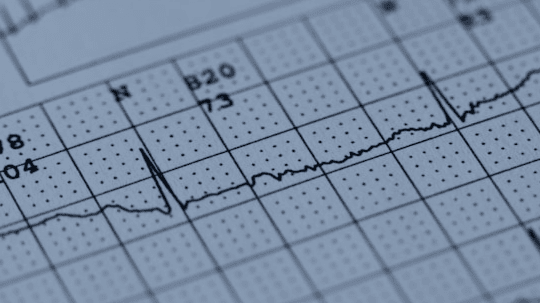 NCLEX Cardiac Rhythms: From Strip to Action