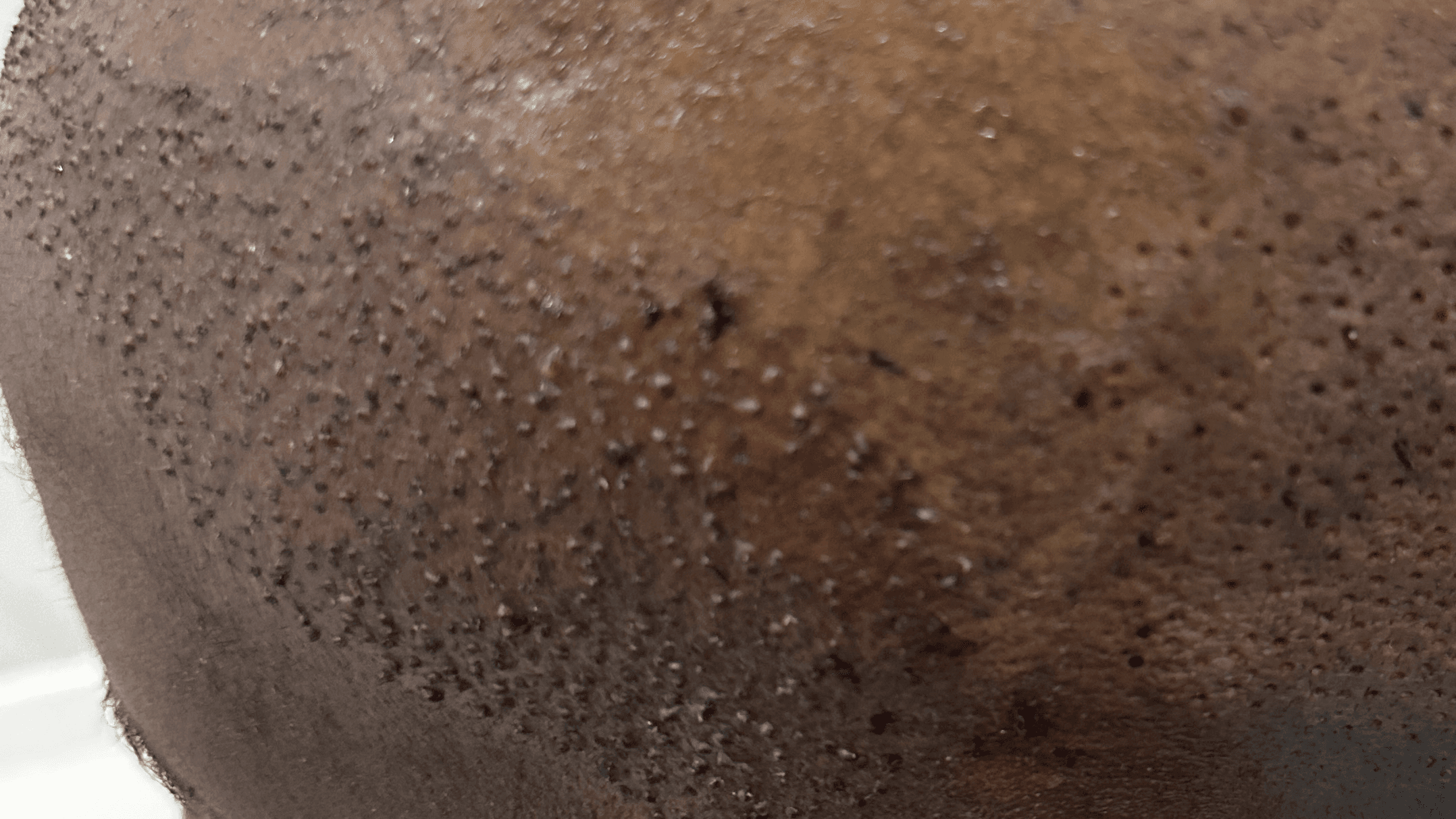 Hair Transplant in Turkey A-Z
