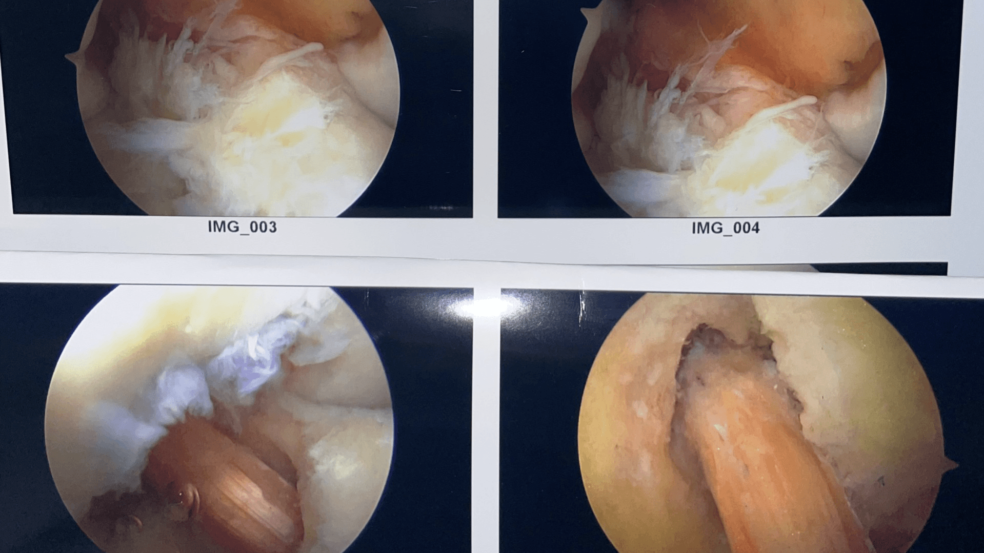 Do You Really Need ACL Surgery