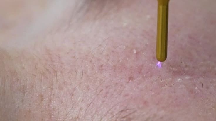 Fibroblast Plasma Pen E-Course