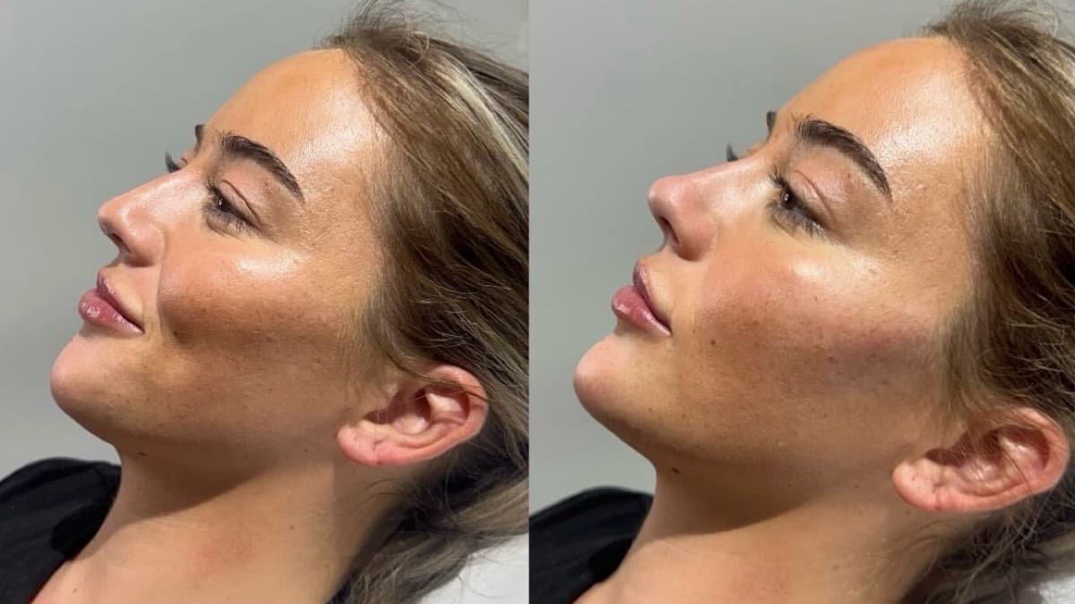 Advanced Rhinoplasty Masterclass