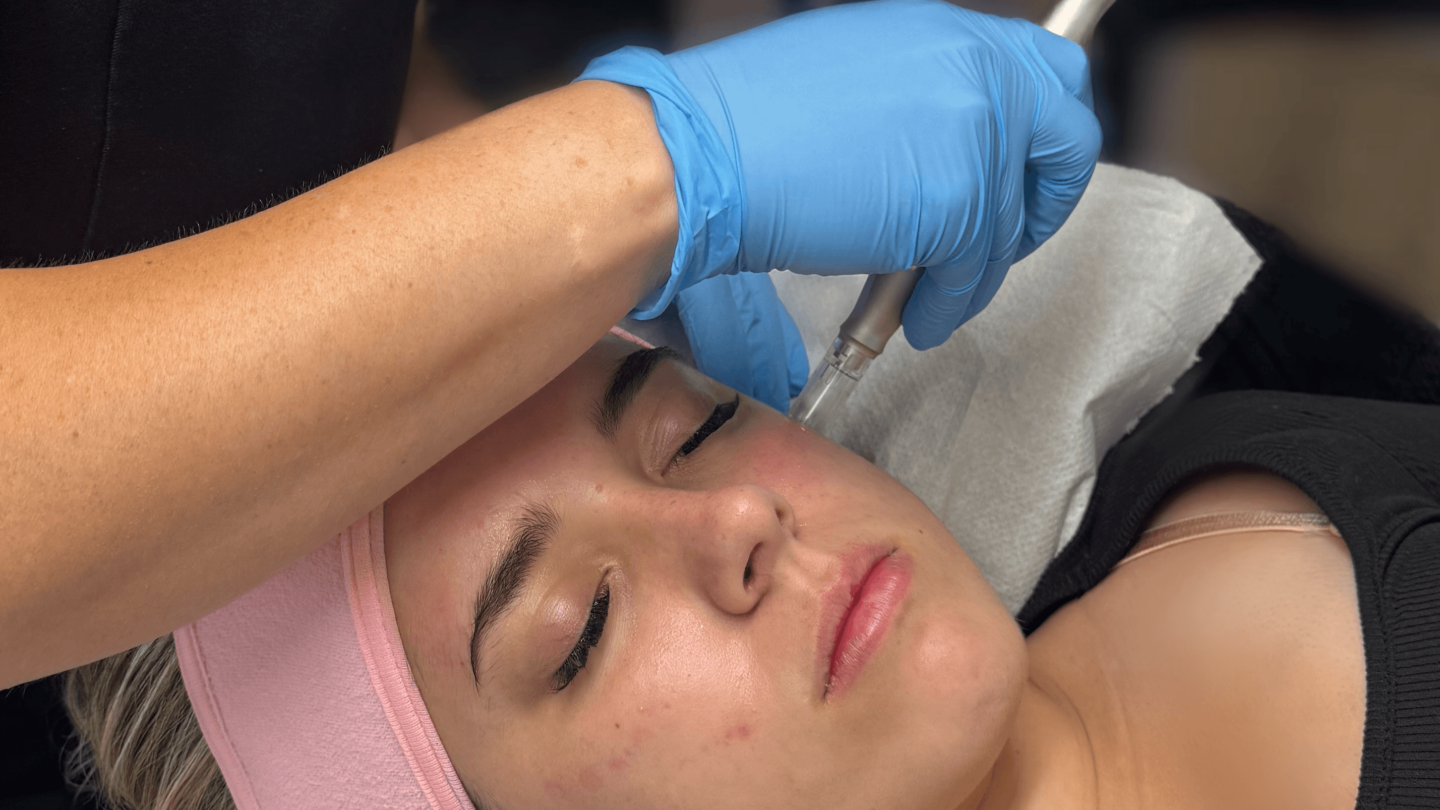 Microneedling Course