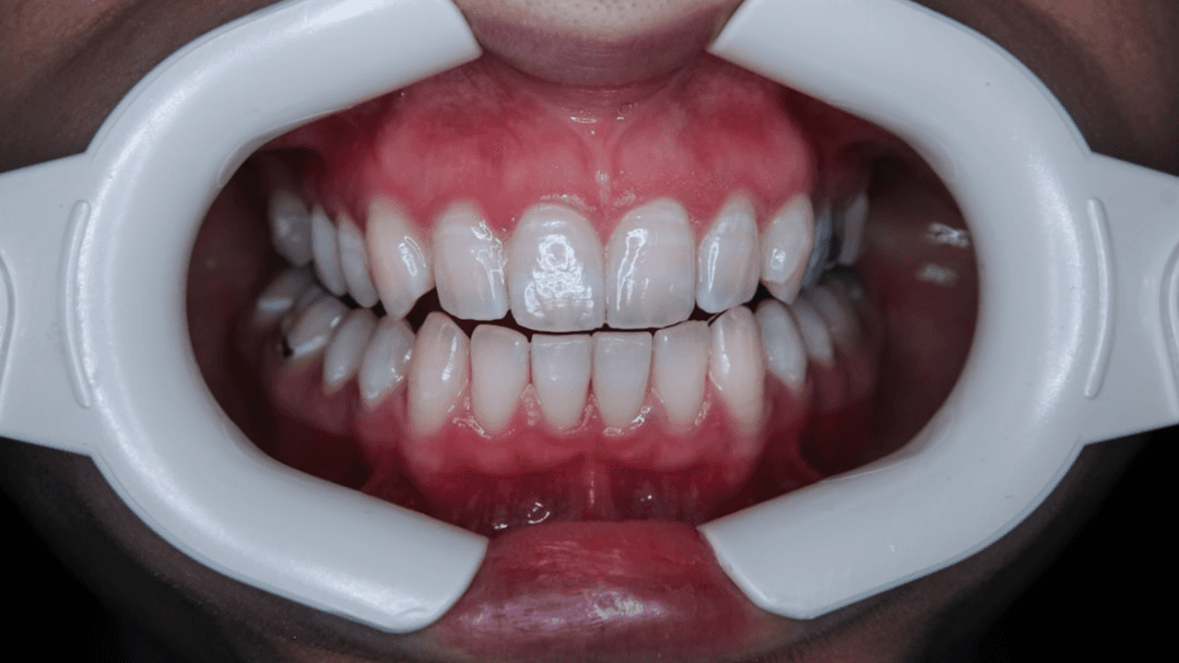 Teeth Whitening Course