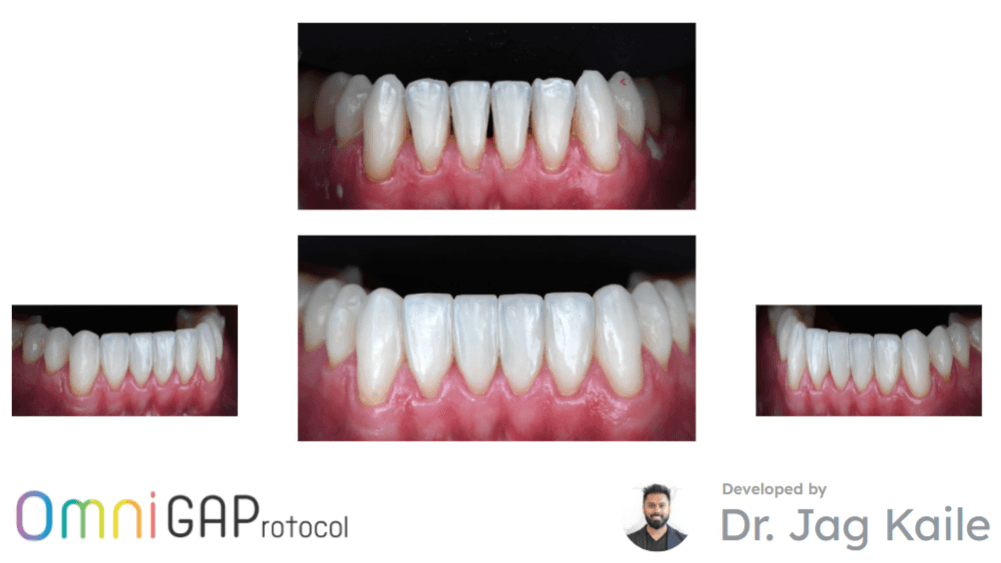 NEW! OmniGap Protocol™- Direct Composite Technique