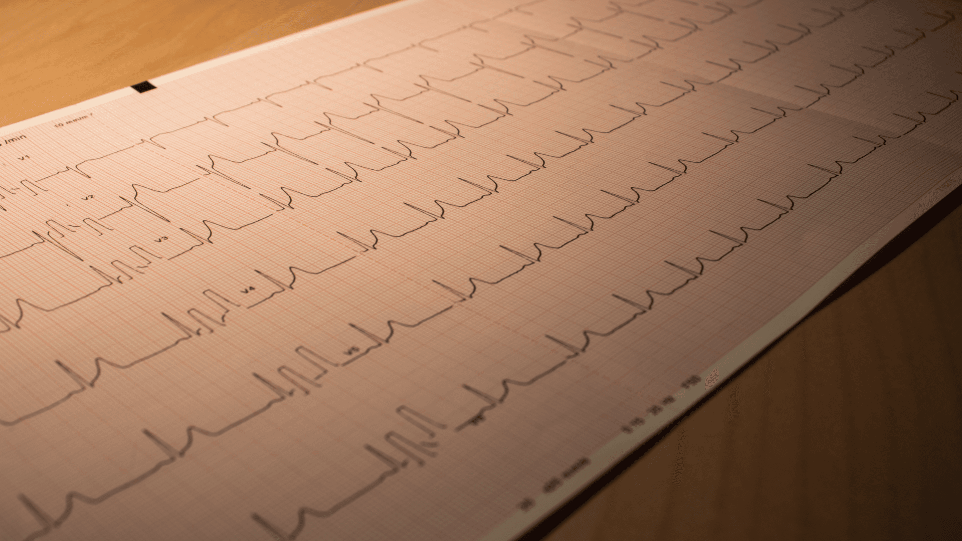 FREE! EKG Introduction Study Guide