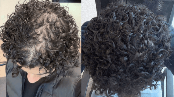 My Reversing Hair loss Routine