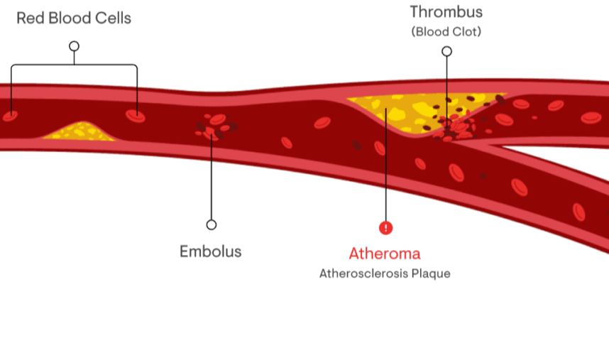 Fix Atherosclerosis