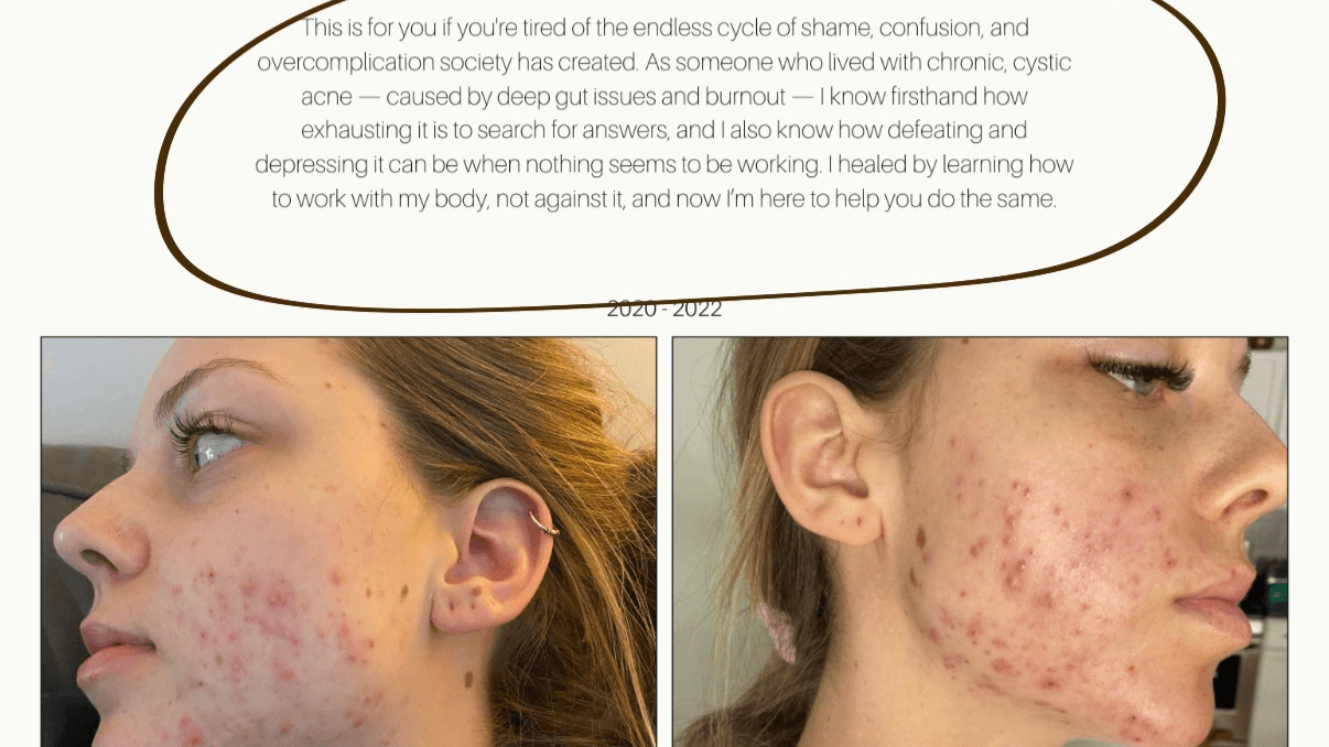 Clear Skin Secrets | Acne Ebook