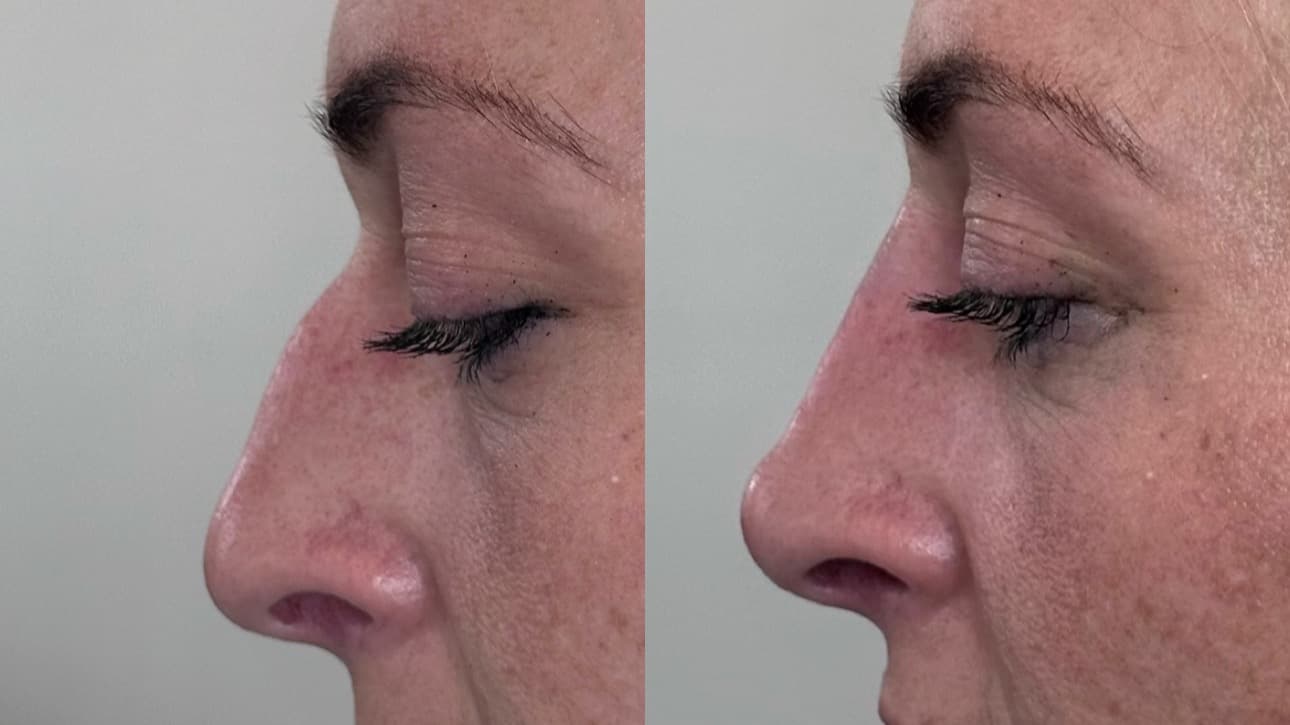 2024 edition: Liquid Rhinoplasty online Class