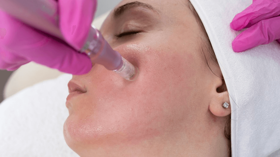 PDRN with Microneedling 4 sessions