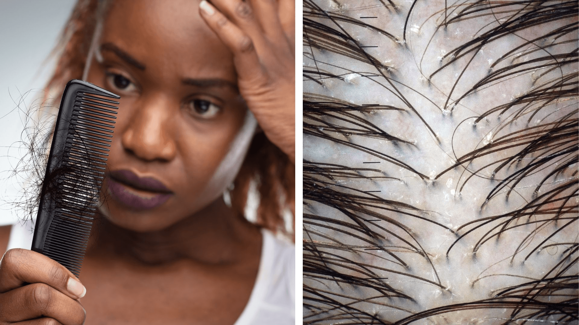 Les 5 causes cachées de la chute de cheveux