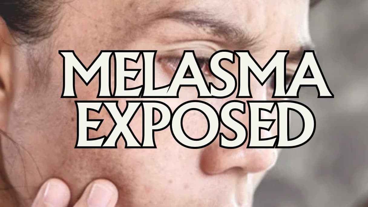Melasma Exposed Free Guide