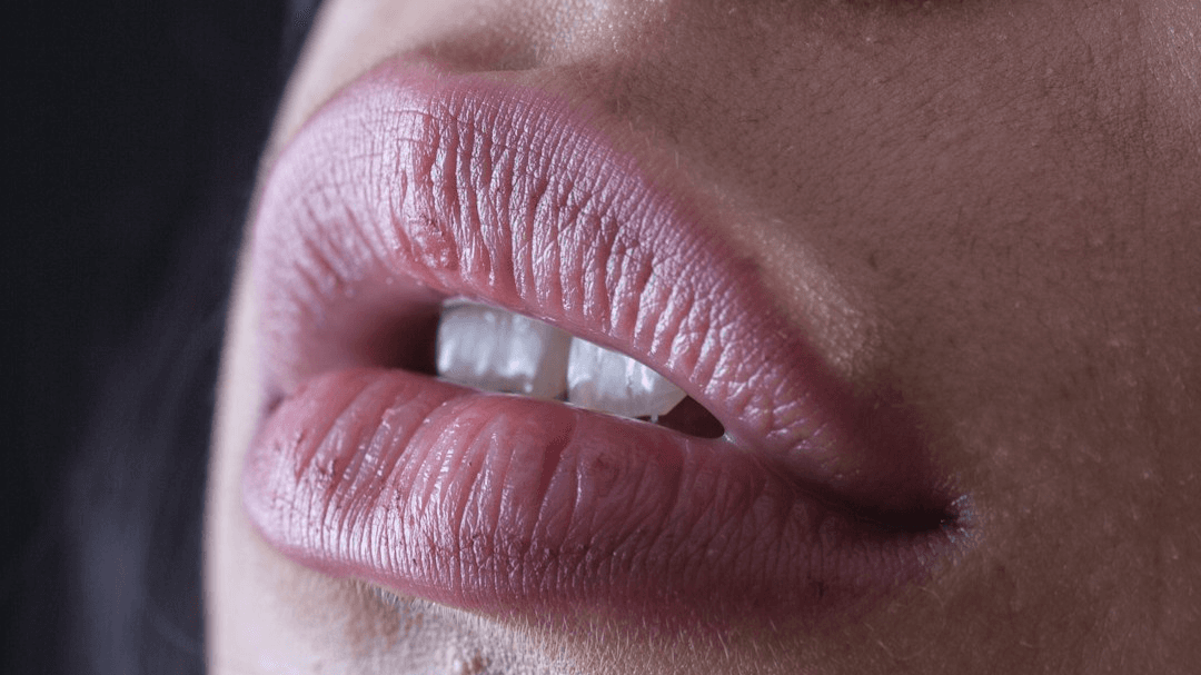 Dermal Filler Consent Form- Attorney Reviewed