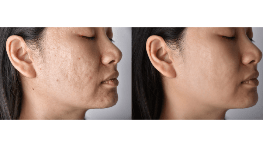 The Clear Skin Blueprint